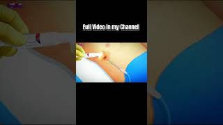 Chest Tube Removal #shorts #chest #tube #nursing #medical