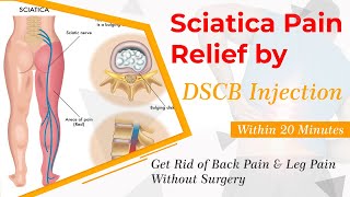 Sciatica Pain Relief within 20 Minutes by DSCB Injection | Lower Back Pain, Leg Pain Relief