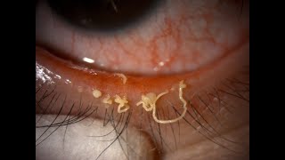 Meibomian Gland Dysfunction (MGD) #ophthalmology #mgd