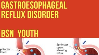 Gastrointestinal disorder . Gastroesophageal reflux disorder   (  Chap -1) Adult Health Nursing   .