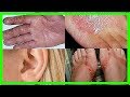 Was ist Kontaktdermatitis und wie man behandelt