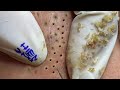 Satisfying video with Hien Nguyen Spa Beauty #015