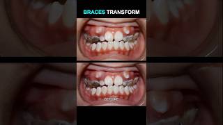 How to move teeth when braces #braces #orthodontist #dentist