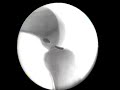 fluoroscopic knee anatomy