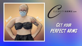 Celebrity Arms™ | Lipo 360° | Forearm Liposuction | High-Definition | Expert Dr. Thomas Su