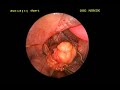 large lipoma in throat surgically removed posterior pharyngeal wall