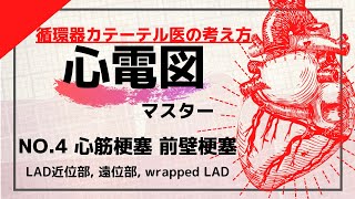 【心電図】No.4 心筋梗塞 前壁梗塞 LAD近位部 LAD遠位部 Wrapped LAD