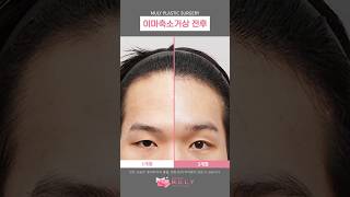 남자 이마축소거상 회복기! #이마축소 #이마거상 #이마축소거상 #남자이마축소 #남자이마거상 #foreheadreduction #foreheadlift