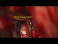 ANTERIOR COMMUNICATING ARTERY  ANEURYSM ACOM-A microsurgery -dr suresh dugani/ HUBLI/INDIA