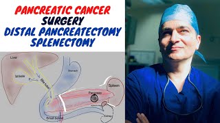 DISTAL PANCREATECTOMY SPLENECTOMY: PANCREATIC CANCER SURGERY
