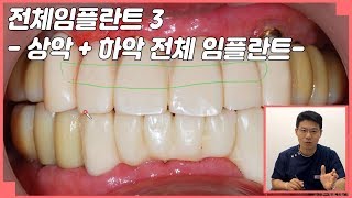 [대전치과, 대전임플란트]전체임플란트 3 - 상악 + 하악 전체 임플란트