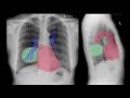 Do you know the hilum overlay sign on chest x-rays?