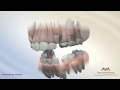 Orthodontic Treatment for Severe Crowding - Serial Extraction