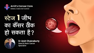 स्टेज I जीभ का कैंसर ठीक हो सकता है या नहीं? | Is Stage I Tongue Cancer curable or not | Dr  Amit C