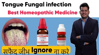 Tongue FUNGAL Infection | ठीक करे 15 Days Me | Homeopathic Medicine | oral candidiasis | Oral Thrush