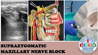 Suprazygomatic Maxillary Nerve Block