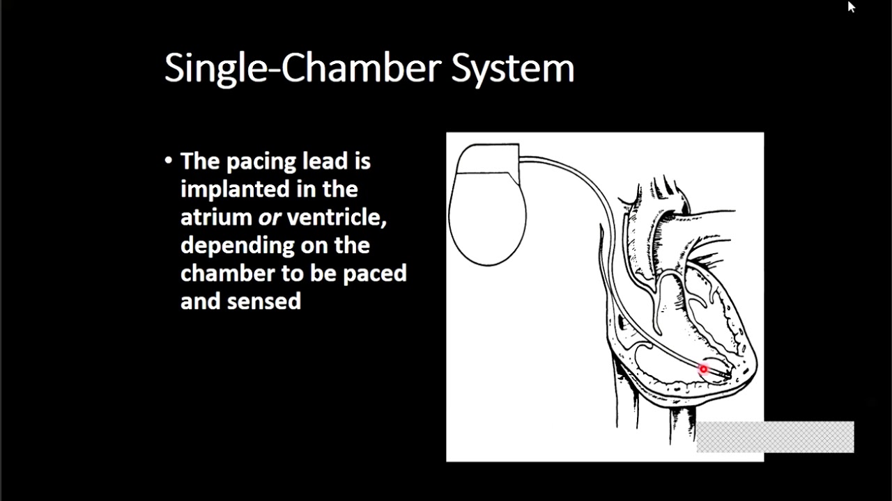 Interpretation Of Pacemaker ECG And Basic Troubleshooting - Dr Maneesh ...