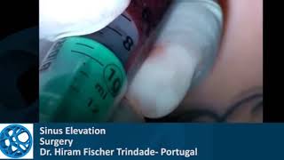 Sinus Elevation Dr Hiram Fischer using Medbone