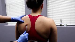 Rhomboid muscle scraping and cupping