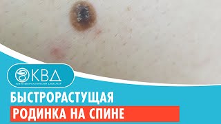 👉 Быстрорастущая родинка на спине. Клинический случай №914