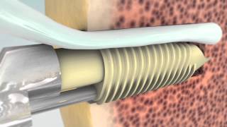 MedShape Eclipse Soft Tissue Anchor - Animation