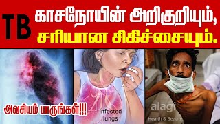 காசநோய் அறிகுறிகள், குணமாக மருத்துவம் | Tuberculosis Symptoms \u0026 Treatment | Causes of TB | Tamil