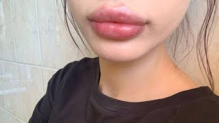 mwah! plump, puffy, wide lips 💉♡ lip filler \u0026 upper lip lift