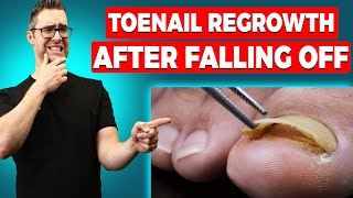 Why are my Toenails Falling Off? [Toenail Regrowth After Falling Off]