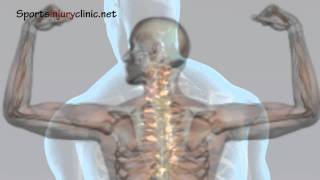 Shoulder Impingement Syndrome - Shoulder pain - Explained in a Minute