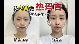 热玛吉也太神了！3个月真实效果反馈｜最全医美抗老干货