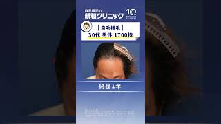 【AGA治療】生え際に1700株移植された体験者様へお話を伺いました。【自毛植毛】【植毛】#shorts