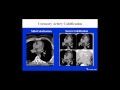 CCTA Training Lecture 7B Coronary Artery Calcification