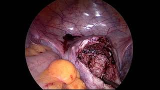 Laparoscopic Adenomyomectomy for Anterior wall adenomyoma