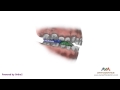 Orthodontic Treatment for Overjet (Overbite) - Twin Block Appliance