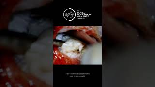 Colesteatoma con endoscopio y con microscopio