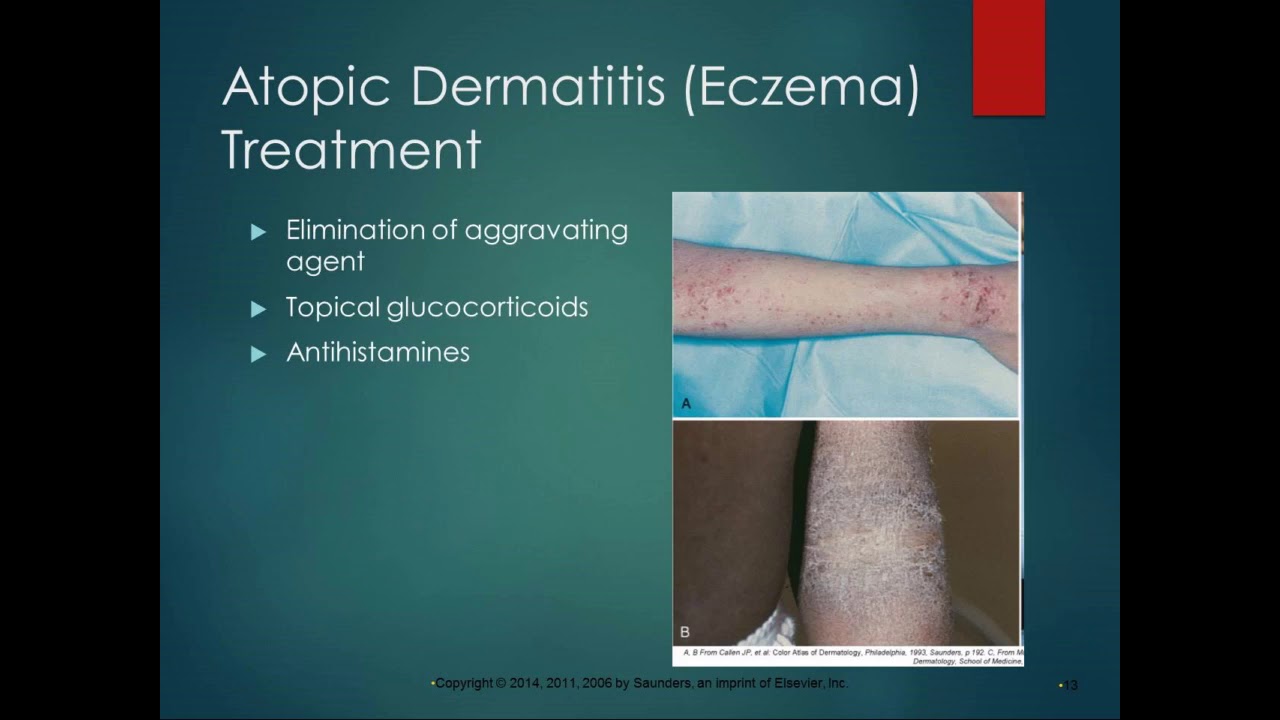 Chapter 8 Lecture Part 2 Skin Disorders - YouTube