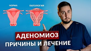 Что такое АДЕНОМИОЗ и кому нужна операция?