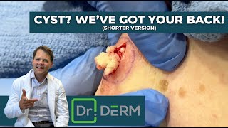 Cyst? We've Got Your Back! (Shorter Version) | Dr. Derm