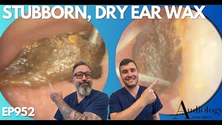 SUPER STUBBORN, DRY EAR WAX REMOVAL - EP952