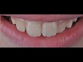 Adhesive rehabilitation of the aesthetic zone