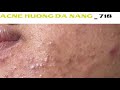 Acne Treatment Huong Da Nang# 718 |   #Remove Blackheads