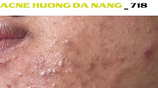 Acne Treatment Huong Da Nang# 718 |   #Remove Blackheads