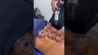 Lower Back Cupping