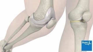 How knee replacement surgery is carried out
