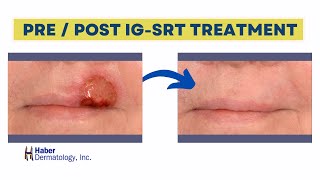Image-Guided SRT Before & After Results | Haber Dermatology