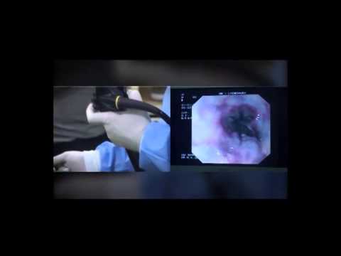 Banding Treatment For Esophageal Variceal Bleeding - YouTube