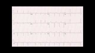 Recognising Atrial Fibrillation (AF) on the 12-lead ECG/EKG