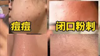 闭口痘痘黑头粗糙暗沉，来看这8瓶精华界翘楚。闭口痘痘黑头护肤