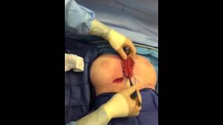 Congenital Symmastia (Uni-boob) Repair