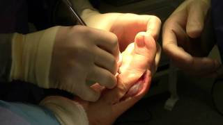 Dr. Nagler performs a Bunionectomy